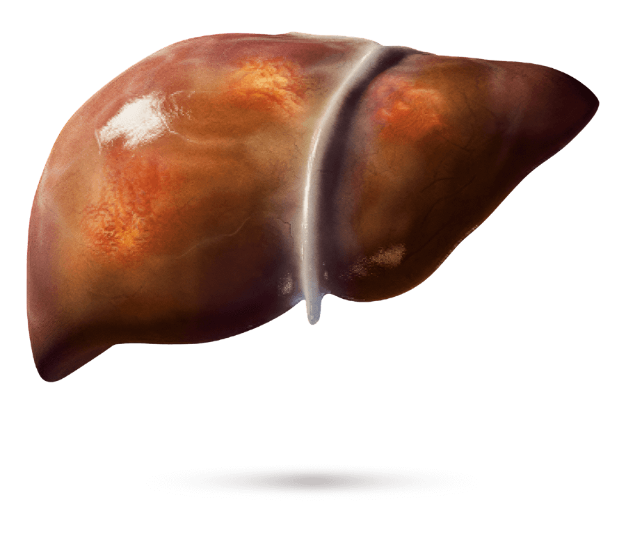 Illustrazione medica di un fegato con fibrosi visibile.