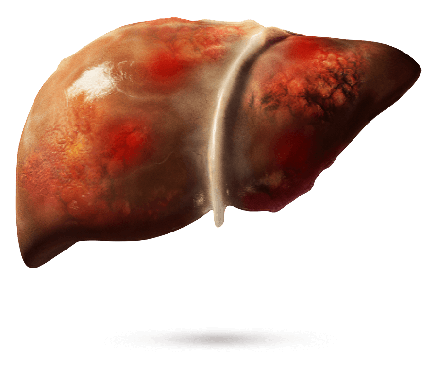 Illustrazione medica di un fegato con fibrosi visibile.