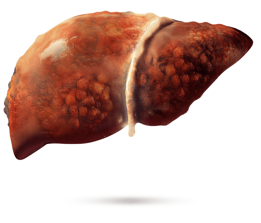 Illustrazione medica di un fegato con fibrosi visibile.